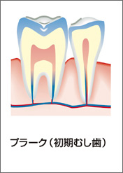 C0：初期虫歯