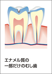 C1：エナメル質の虫歯