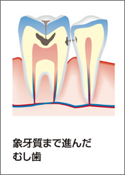 C2：象牙質まで進んだ虫歯