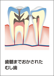 C3：歯髄まで進んだ虫歯