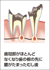 C4：歯根だけ残ったむし歯