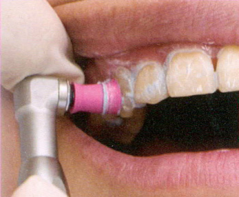 STEP1　ホワイトニングに関するご説明と歯の表面のクリーニング